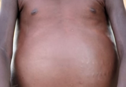 La pancia gonfia del bimbo africano: è polemica sulla raccolta fondi